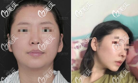 劉彥軍醫(yī)生隆鼻案例