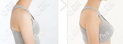 泉州歐菲自體脂肪豐胸案例 泉州歐菲自體脂肪豐胸案例