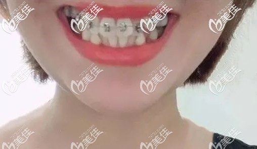我剛戴牙套時(shí)牙齒的樣子 我剛戴牙套時(shí)牙齒的樣子