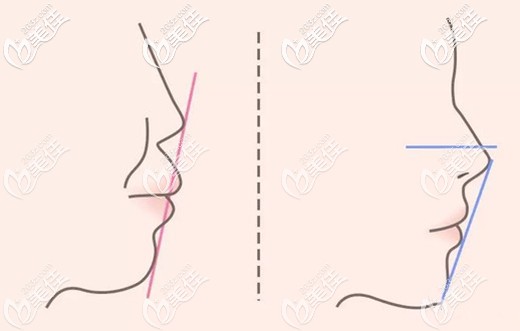 在重慶矯正牙齒后的側(cè)貌變化效果圖 在重慶矯正牙齒后的側(cè)貌變化效果圖
