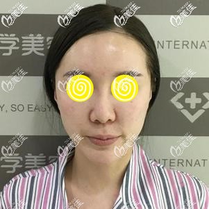 做鼻綜合手術(shù)前難看的鼻形 做鼻綜合手術(shù)前難看的鼻形