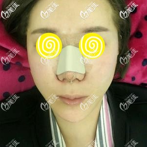 找阪田和明醫(yī)生做鼻綜合術(shù)后效果明顯 找阪田和明醫(yī)生做鼻綜合術(shù)后效果明顯