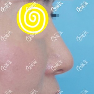 都說日本酒井直彥醫(yī)生做鼻子漂亮，其實(shí)阪田和明醫(yī)生做的鼻綜合手術(shù)效果也比較自然