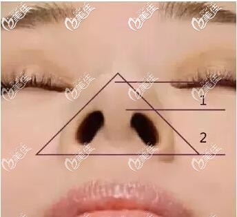 正常的鼻小柱 正常的鼻小柱