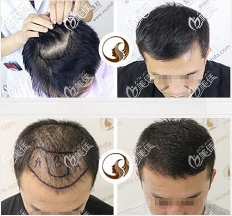 頭頂加密種植案例效果圖