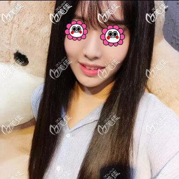 埋線提升術后半個月