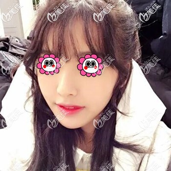 用我做面部埋線提升打造小v臉的親身經(jīng)歷來告訴你術后多久有效果？