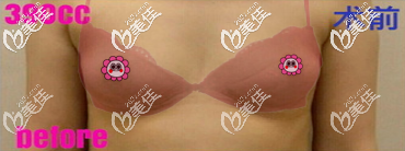 在泰國(guó)曼古雨季做假體隆胸前樣子 在泰國(guó)曼古雨季做假體隆胸前樣子