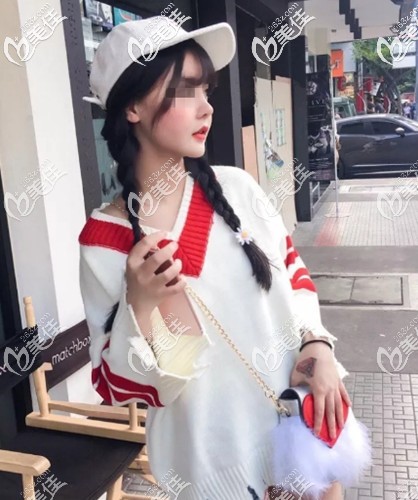 千萬不要做肋軟骨隆鼻 我覺得用硅膠+耳軟骨的鼻綜合術(shù)后效果就挺自然精致