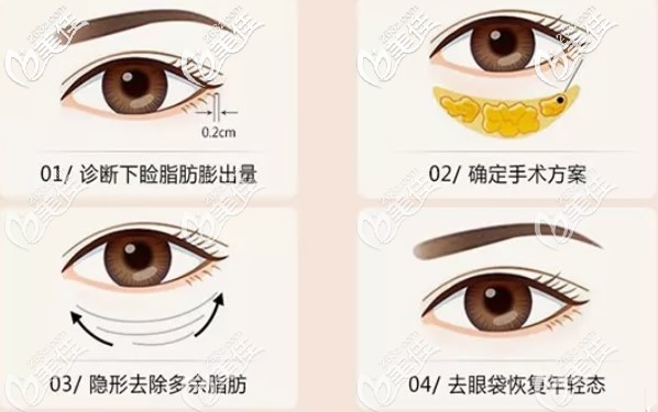 聚能美雕祛眼袋過程