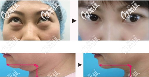 聚能美雕去除眼袋和雙下巴效果