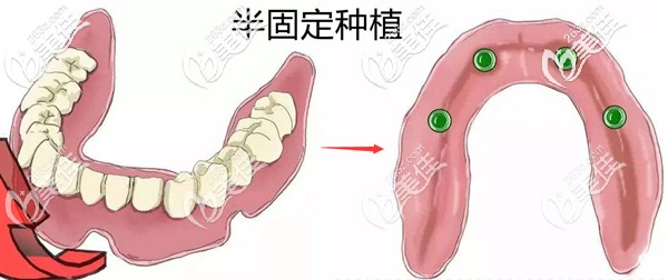 半固定種植牙的原理示意圖 半固定種植牙的原理示意圖