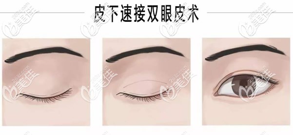 皮下速接雙眼皮手術(shù)步驟 皮下速接雙眼皮手術(shù)步驟