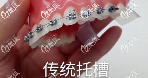 傳統(tǒng)金屬托槽矯正器 傳統(tǒng)金屬托槽矯正器