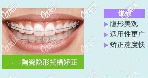 半隱形陶瓷托槽矯正器 半隱形陶瓷托槽矯正器