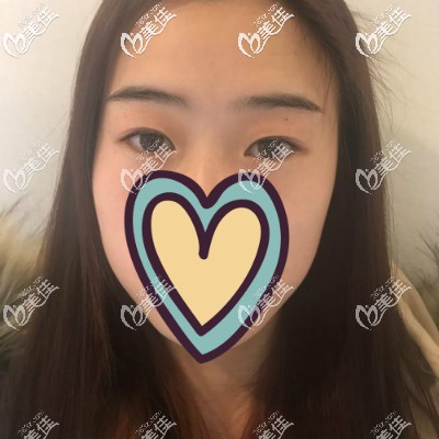 做眼綜合術(shù)前照片 做眼綜合術(shù)前照片