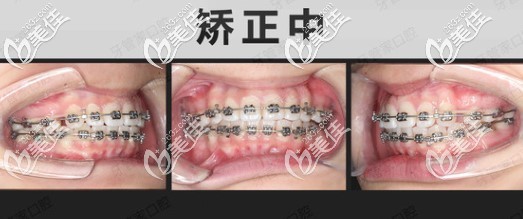 骨性齙牙做金屬自鎖托槽矯正中