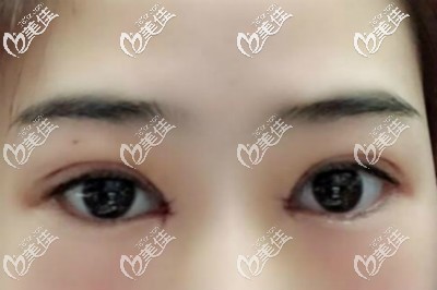 眼綜合術(shù)后第10天恢復(fù)圖 眼綜合術(shù)后第10天恢復(fù)圖