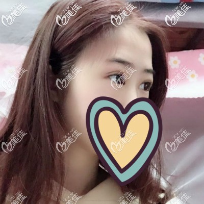 眼綜合手術(shù)20天恢復(fù)圖 眼綜合手術(shù)20天恢復(fù)圖