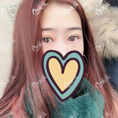 眼綜合術(shù)后三個(gè)月恢復(fù)得越來(lái)越自然好看 眼綜合術(shù)后三個(gè)月恢復(fù)得越來(lái)越自然好看