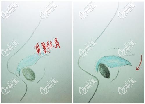 鼻翼緣退縮多數(shù)都要把鼻翼軟骨下拉改善 鼻翼緣退縮多數(shù)都要把鼻翼軟骨下拉改善