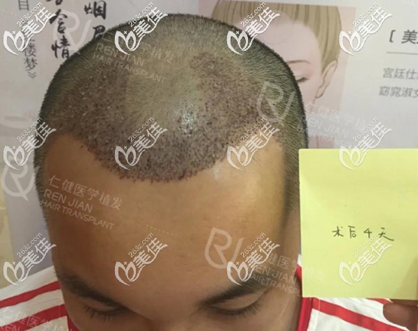 發(fā)際線種植4天小發(fā)茬已經(jīng)長出來了