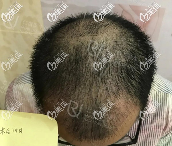 植發(fā)一個月進入脫落期