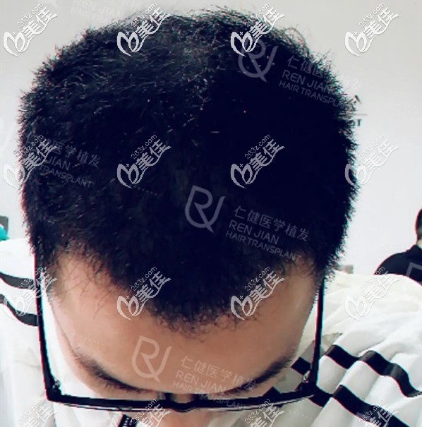 發(fā)際線種植術(shù)后5個月頭發(fā)進入生長期