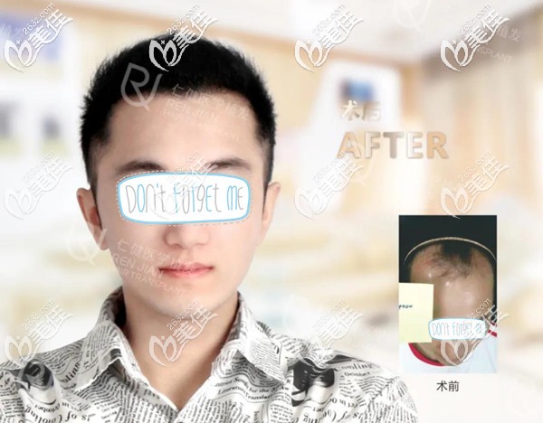 m型發(fā)際線要植發(fā)多少個(gè)單位?微針發(fā)際線種植2300毛囊術(shù)后恢復(fù)期過(guò)程記錄