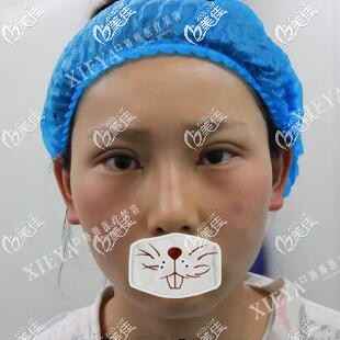 雙眼皮開眼角術(shù)后即刻效果照 雙眼皮開眼角術(shù)后即刻效果照