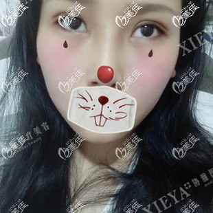 雙眼皮開內(nèi)眼角術(shù)后24天恢復效果照 雙眼皮開內(nèi)眼角術(shù)后24天恢復效果照