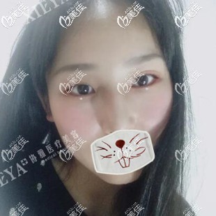 這是我做雙眼皮開內(nèi)眼角術后40多天的恢復效果圖片，大家覺得怎么樣??？