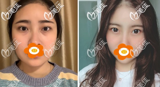 分享姐妹們做埋線提升面部親身經(jīng)歷,一起來看臉部埋線后多久可以恢復