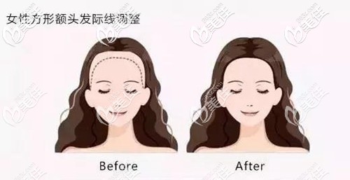女性方形額頭發(fā)際線調(diào)整 女性方形額頭發(fā)際線調(diào)整