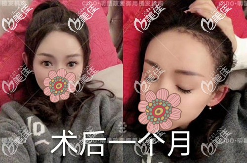 前額發(fā)際線種植一個(gè)月效果圖 前額發(fā)際線種植一個(gè)月效果圖
