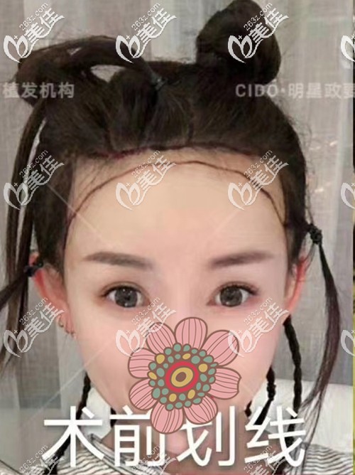 術(shù)前設(shè)計(jì)發(fā)際線種植線條 術(shù)前設(shè)計(jì)發(fā)際線種植線條