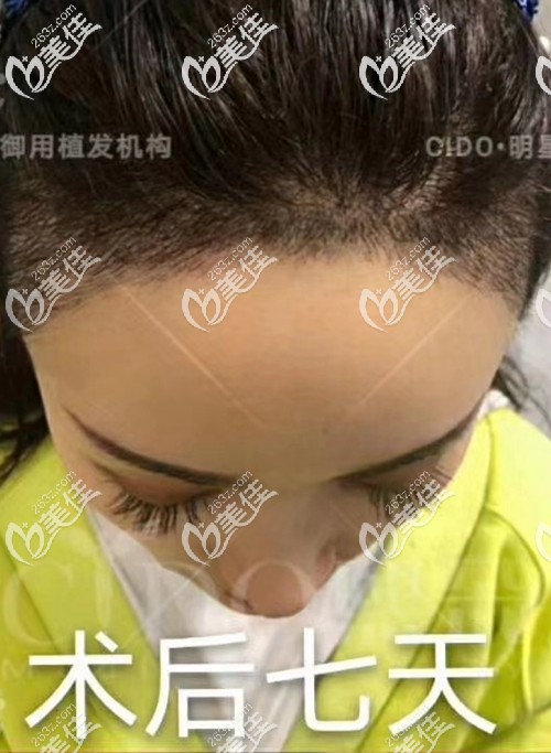 看到我用AHT技術(shù)植發(fā)際線一個(gè)月的效果圖，我感覺我不做發(fā)際線種植才會(huì)后悔終身吧!