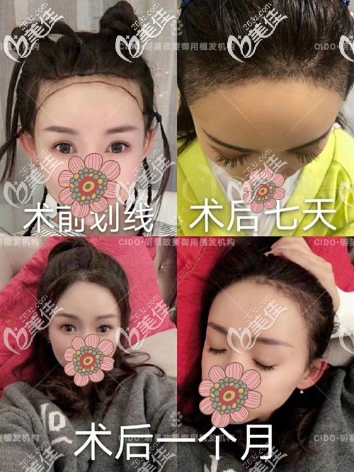 發(fā)際線種植手術(shù)恢復(fù)過(guò)程 發(fā)際線種植手術(shù)恢復(fù)過(guò)程