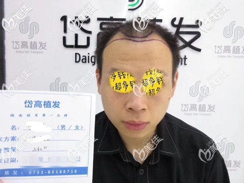 術(shù)前發(fā)際線脫發(fā)、頭發(fā)稀疏