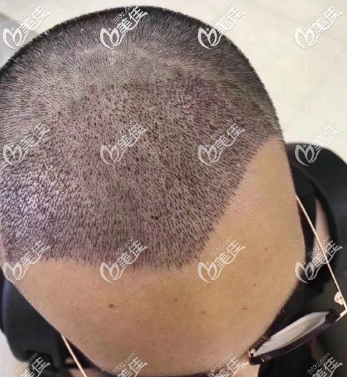 做了前額發(fā)際線種植術(shù)后第4天 做了前額發(fā)際線種植術(shù)后第4天