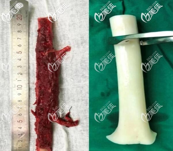 異體骨隆鼻材料