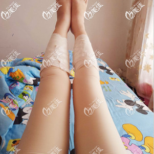 吸脂瘦大腿術(shù)后7天腿部依舊腫脹