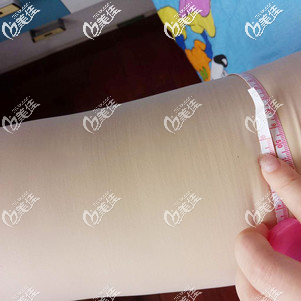 大腿吸脂術(shù)后25天腿圍有了變化