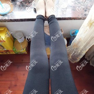 大腿吸脂10天依舊腫脹，擔(dān)心手術(shù)失敗的寶寶看我環(huán)吸親身經(jīng)歷了解術(shù)后多久腿能變細(xì)