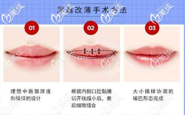 厚唇改薄手術(shù)方法 厚唇改薄手術(shù)方法