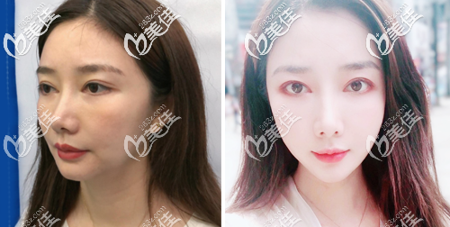 深圳非凡第五代熱瑪吉全臉案例對比圖片 深圳非凡第五代熱瑪吉全臉案例對比圖片