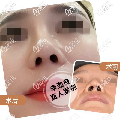 李勁良院長鼻小柱整形案例 李勁良院長鼻小柱整形案例