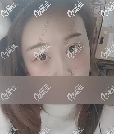 赤峰紫潔去眼袋第二天