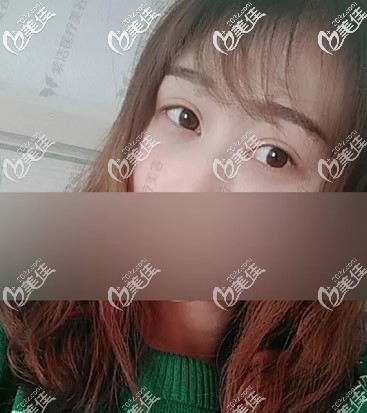 無痕去眼袋+自體脂肪填充淚溝第十天效果