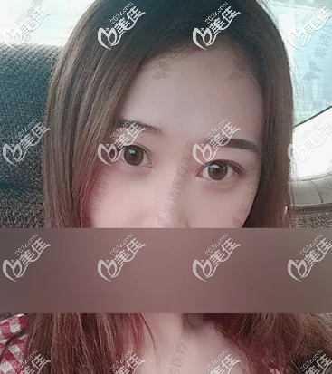 不要再說赤峰紫潔不開刀去眼袋是騙局了,看過劉文峰院長眼袋手術(shù)1--10天圖片你就懂了!